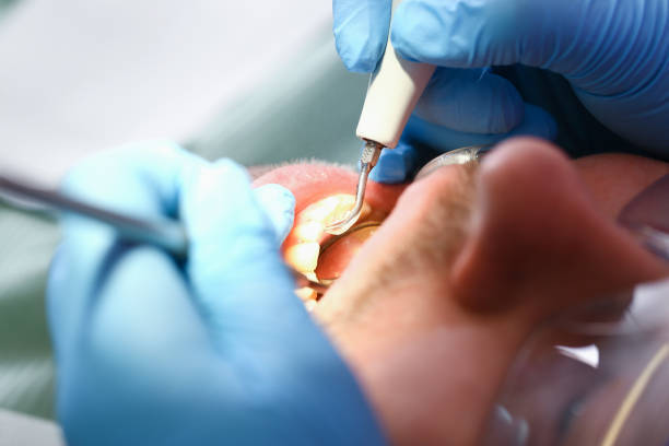 Best Emergency Root Canal Treatment in Essex Village, CT