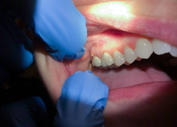 Best Emergency Dentist for Lost Fillings or Crowns in Essex Village, CT